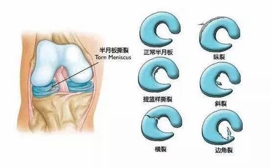 半月板到底是个什么“板”？-昭通李景铧中医骨伤医院